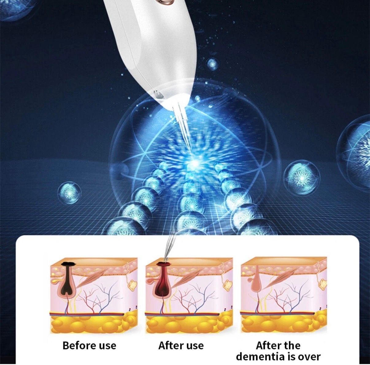 9-Level LCD Laser Plasma Pen for Skin Tag, Mole, and Spot Removal 4
